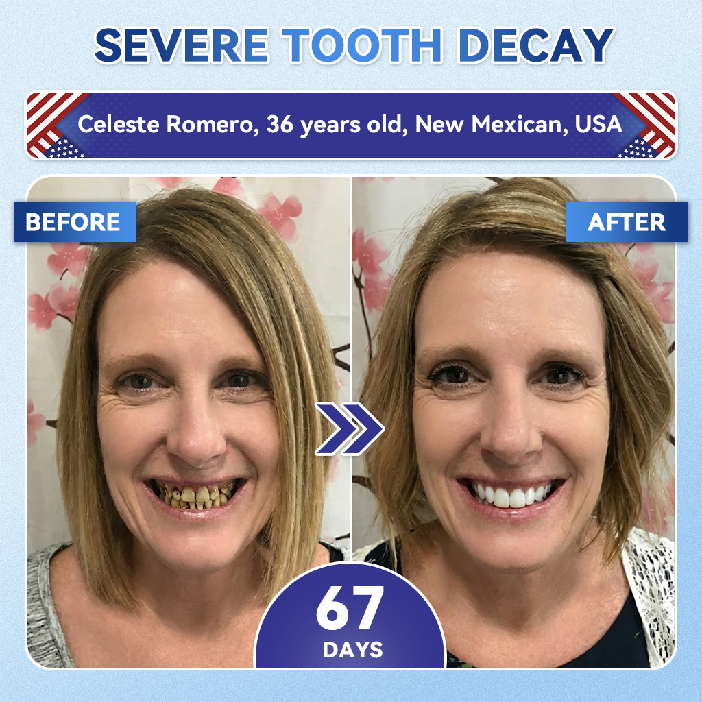 ZUEET® 🦷 Tideglusib Fast‑Dissolving Tooth & Gum Repair Oral Strips ✨ (Supports tooth repair and helps relieve gum discomfort and other common oral concerns)